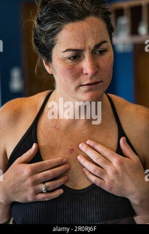 Young 30s caucasian female shows worry after superficial basal cell carcinoma skin cancer diagnosis. Stock Photo