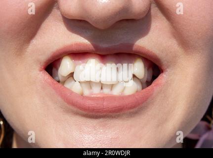 Curved female teeth, before installing braces. Close - up of teeth before treatment by an orthodontist Stock Photo