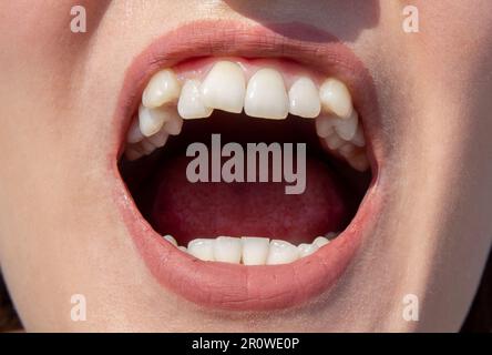 Curved female teeth, before installing braces. Close - up of teeth before treatment by an orthodontist Stock Photo