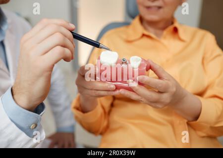 Closeup of unrecognizable dentist pointing at tooth model while explaining dental implant surgery to patient in clinic Stock Photo
