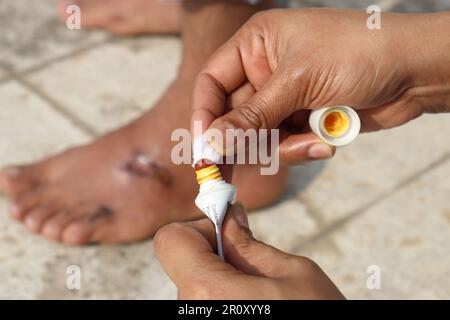Close up of taking ointment in the cotton to apply on the wound with semi dried wound in the background. First aid concept. Stock Photo