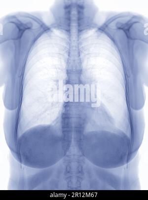 Chest x-ray image Negative filter. Stock Photo