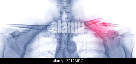 X-ray of Clavicle AP view showing fracture of left Clavicle bone. Stock Photo