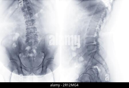 X-ray image of lumbar Spine or L-s spine AP and lateral view for ...