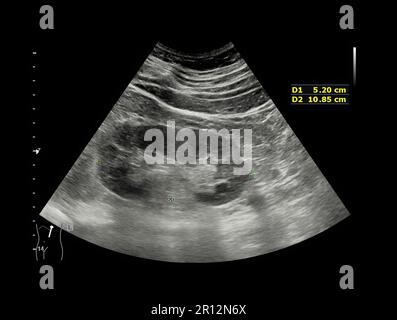 Ultrasound of Kidney  or KUB  for  screening  renal stone disease or Urolithiasis. Stock Photo