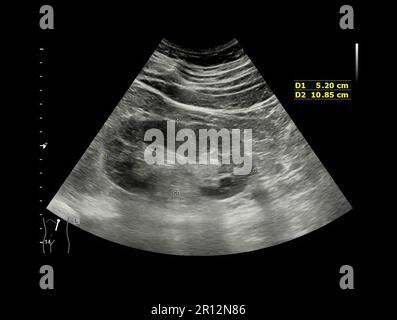 Ultrasound of Kidney  or KUB  for  screening  renal stone disease or Urolithiasis. Stock Photo