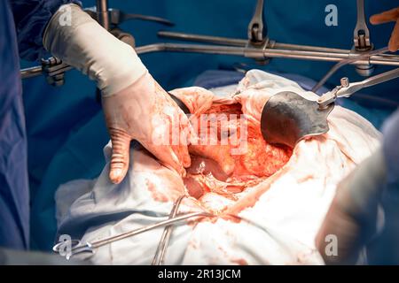 Close-up of the hands of surgeons during an operation on the open abdomen of a patient, sterile medical instruments, teamwork. Stock Photo