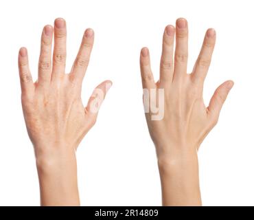 Collage with photos of woman showing hands with dry and moisturized skin on white background, closeup Stock Photo