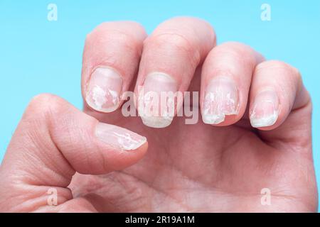 Flaky bitten and brittle nails without a manicure. Regrown nail cuticle and damaged nail plate after gel polish on blue background. Stock Photo