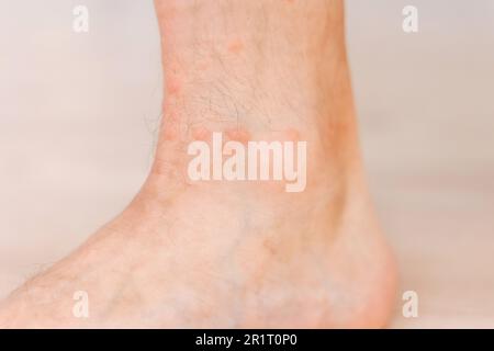 Skin allergy caused by mosquito bites Stock Photo - Alamy