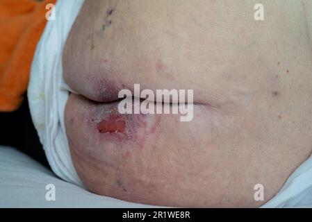 Early stage bedsore (pressure ulcers) on a buttock area Stock Photo