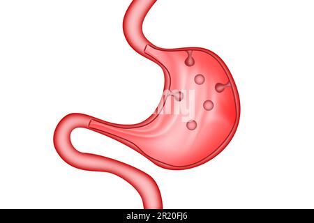 Stomach polyps of the digestive system, 3d rendering Stock Photo