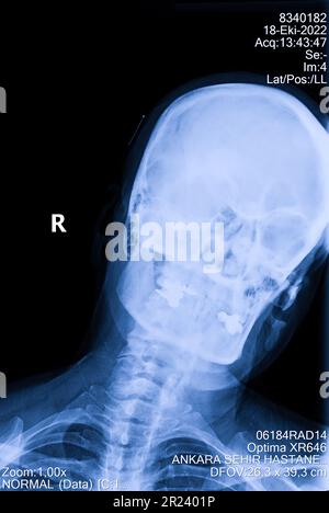 Human cervical spine x-ray, neck radiography Stock Photo
