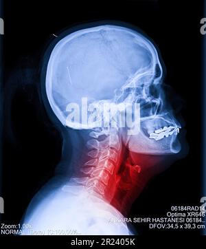 X-ray of neck and cervical spine view. Image of radiography from patient who have neck pain, nerve root compression, numbness at arm hand wrist or fin Stock Photo