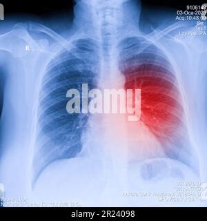 X-Ray Image Of Human Chest for a medical diagnosis, shows pain area with red. Thorax x-ray for lungs examination, PA up right Stock Photo