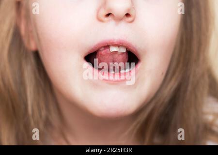 Close up portrait of a smiling happy little child girl with long hair moving her milk front tooth with her tongue in open mouth. Milk teeth loss conce Stock Photo