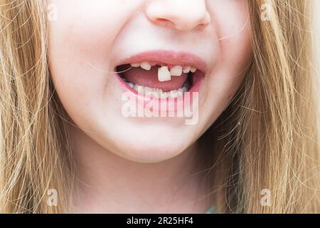 Close up portrait of a smiling happy little child girl with long hair moving her milk front tooth with her tongue in open mouth. Milk teeth loss conce Stock Photo