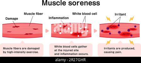 Mechanism of muscle soreness vector illustration Stock Vector