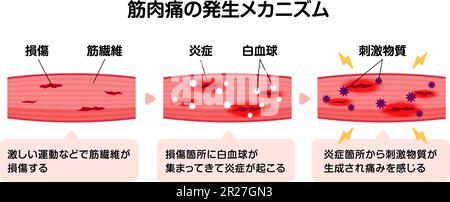 Mechanism of muscle soreness vector illustration Stock Vector