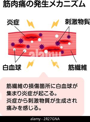 Mechanism of muscle soreness vector illustration Stock Vector