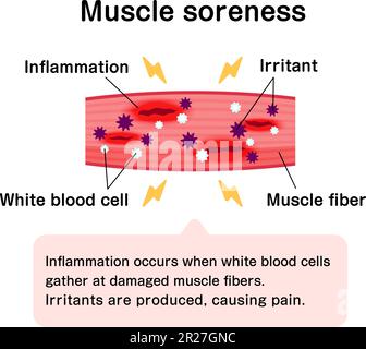 Mechanism of muscle soreness vector illustration Stock Vector