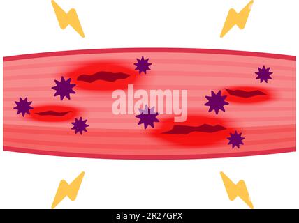 Mechanism of muscle soreness vector illustration Stock Vector