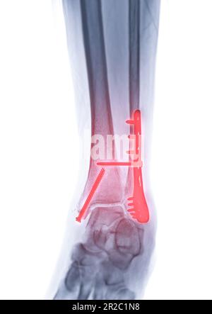 X-ray Image Of Ankle Joint Showing Fracture Of Ankle Joint Stock Photo 