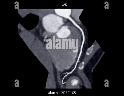 CTA coronary artery Curve refomation showing left coronary artery . Stock Photo