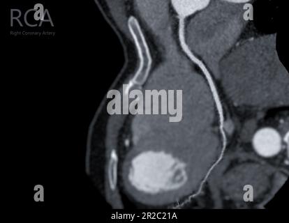 CTA coronary artery Curve refomation showing Right coronary artery . Stock Photo
