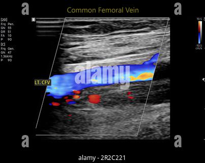 Color Doppler ultrasound determination in deep vein thrombosis patients for finding  deep vein thrombosis of lower extremity. Stock Photo