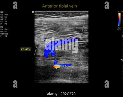 Color Doppler ultrasound determination in deep vein thrombosis patients for finding  deep vein thrombosis of lower extremity. Stock Photo