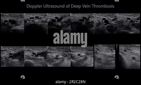 Color Doppler ultrasound determination in deep vein thrombosis patients for finding  deep vein thrombosis of lower extremity. Stock Photo