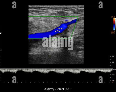 Color Doppler ultrasound determination in deep vein thrombosis patients for finding  deep vein thrombosis of lower extremity. Stock Photo