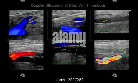 Color Doppler ultrasound determination in deep vein thrombosis patients for finding  deep vein thrombosis of lower extremity. Stock Photo