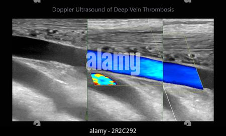 Color Doppler ultrasound determination in deep vein thrombosis patients for finding  deep vein thrombosis of lower extremity. Stock Photo