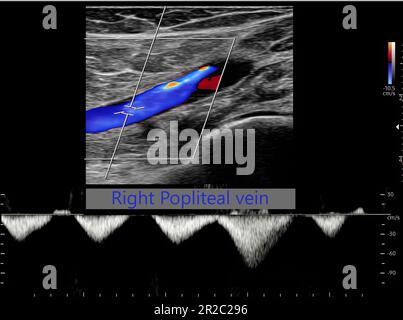 Color Doppler ultrasound determination in deep vein thrombosis patients for finding  deep vein thrombosis of lower extremity. Stock Photo