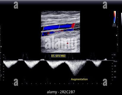 Color Doppler ultrasound determination in deep vein thrombosis patients for finding  deep vein thrombosis of lower extremity. Stock Photo