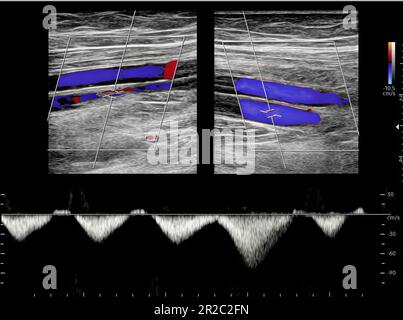 Color Doppler ultrasound determination in deep vein thrombosis patients for finding  deep vein thrombosis of lower extremity. Stock Photo