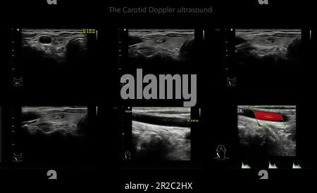 A carotid artery Doppler ultrasound is a diagnostic test used to check the arteries in the neck for diagnosis  any blockage in the veins by a blood cl Stock Photo