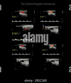 A carotid artery Doppler ultrasound is a diagnostic test used to check the arteries in the neck for diagnosis  any blockage in the veins by a blood cl Stock Photo