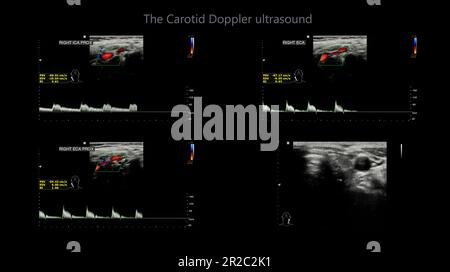 A carotid artery Doppler ultrasound is a diagnostic test used to check the arteries in the neck for diagnosis  any blockage in the veins by a blood cl Stock Photo