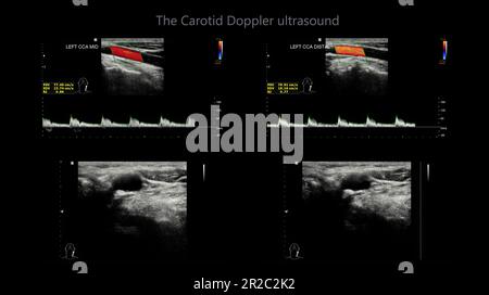 A carotid artery Doppler ultrasound is a diagnostic test used to check ...