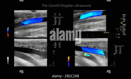 A carotid artery Doppler ultrasound is a diagnostic test used to check the arteries in the neck for diagnosis  any blockage in the veins by a blood cl Stock Photo