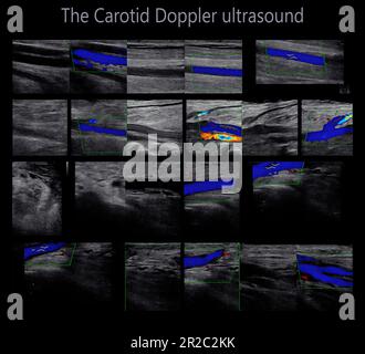 A carotid artery Doppler ultrasound is a diagnostic test used to check the arteries in the neck for diagnosis  any blockage in the veins by a blood cl Stock Photo