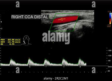 A carotid artery Doppler ultrasound is a diagnostic test used to check the arteries in the neck for diagnosis  any blockage in the veins by a blood cl Stock Photo