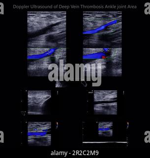 Color Doppler ultrasound determination in deep vein thrombosis patients for finding  deep vein thrombosis of lower extremity. Stock Photo