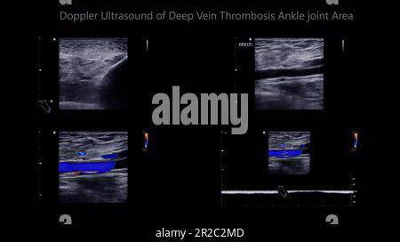 Color Doppler ultrasound determination in deep vein thrombosis patients for finding  deep vein thrombosis of lower extremity. Stock Photo