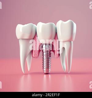 Close up of dental teeth implant. 3D rendering. Stock Photo