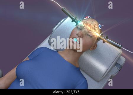 Electroconvulsive therapy, illustration Stock Photo