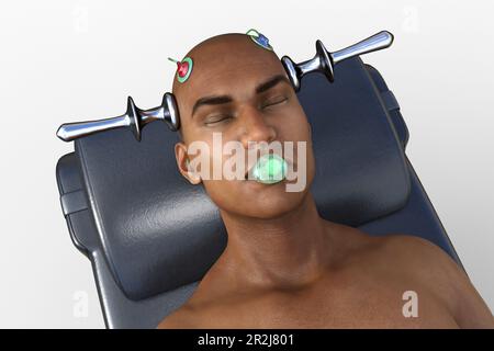 Electroconvulsive therapy, illustration Stock Photo